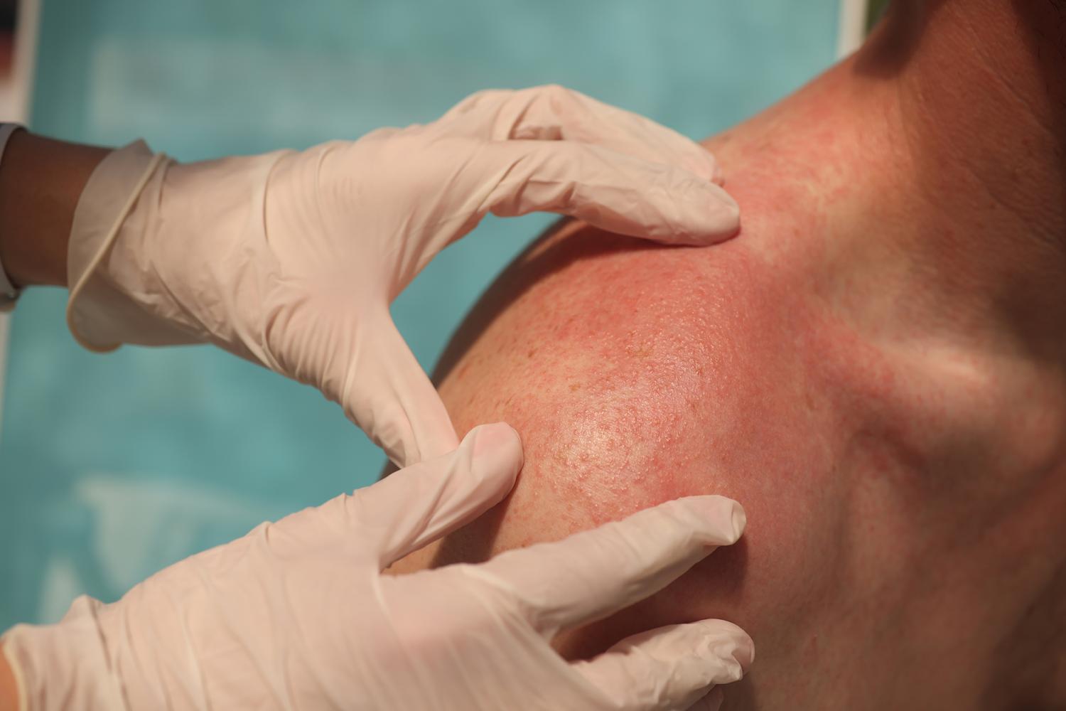 Dermatology